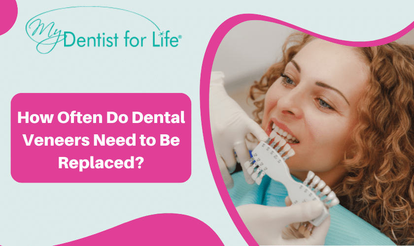 How Often Do Dental Veneers Need to Be Replaced