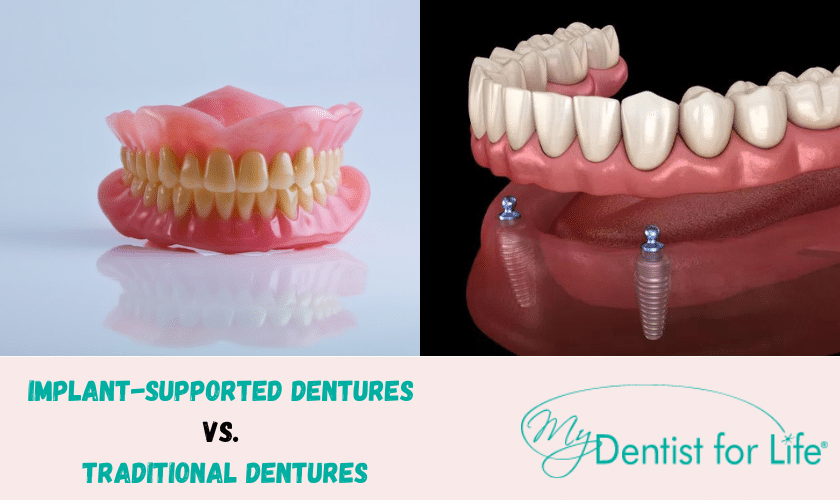 Implant-Supported Dentures vs. Traditional Dentures