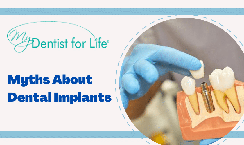 Myths About Dental Implants You Should Know
