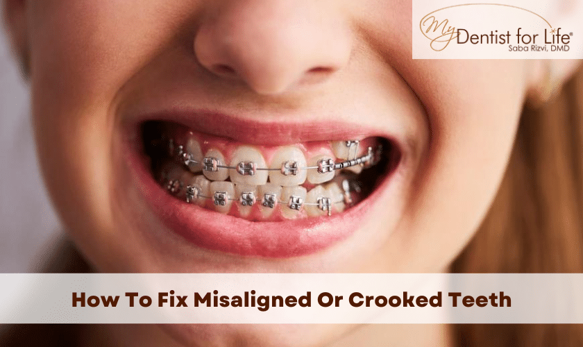 How To Fix Misaligned Or Crooked Teeth