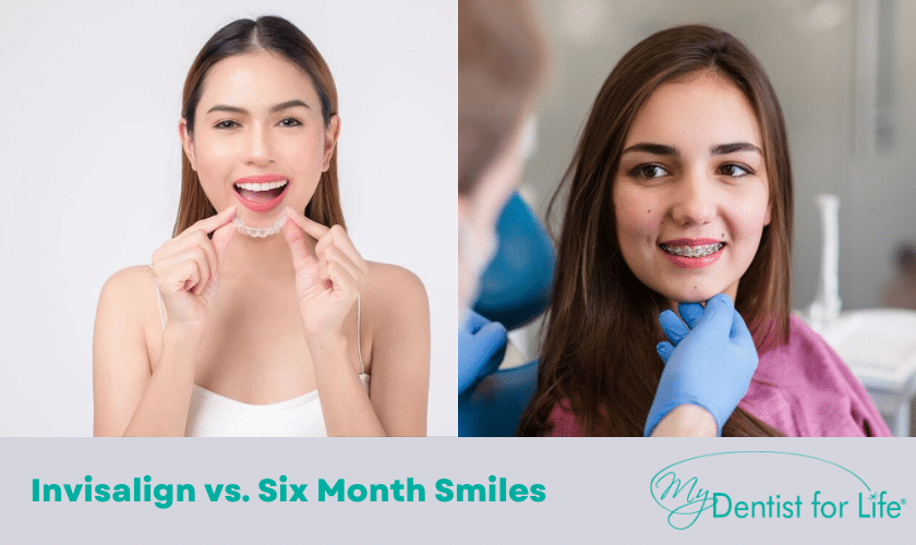 Invisalign vs. Six Month Smiles