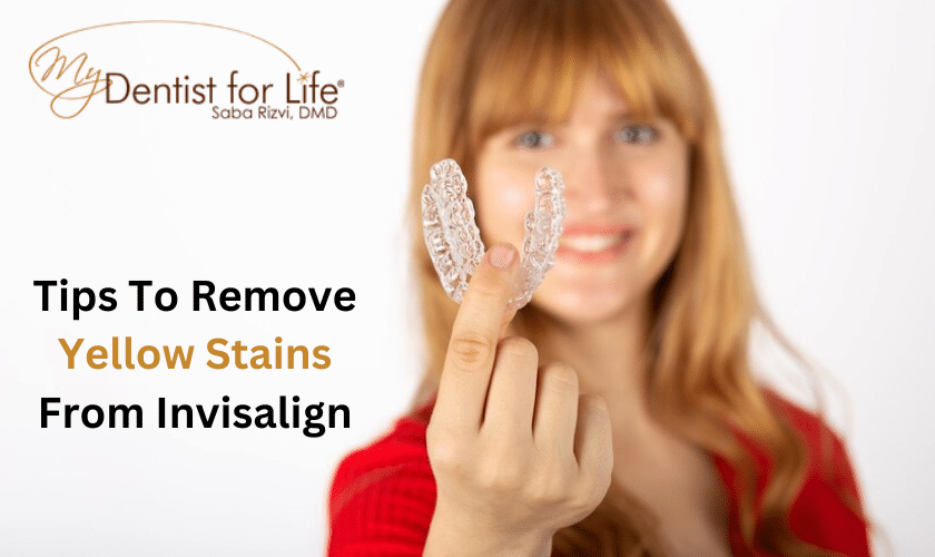Tips To Remove Yellow Stains From Invisalign (1)