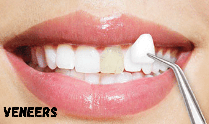 Dental Veneers Plantation