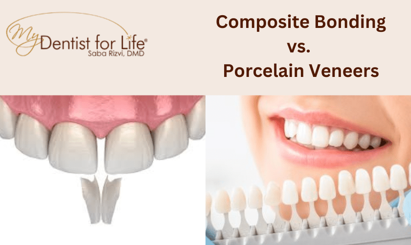Composite Bonding vs. Porcelain Veneers