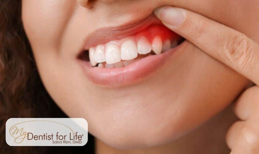 5 Tricks to Stop Gum Disease Before it Starts