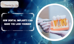 How Dental Implants Can Make You Look Younger