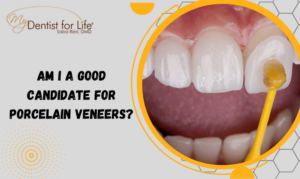 Am I a Good Candidate for Porcelain Veneers