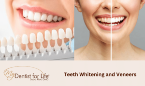 Teeth Whitening and Veneers