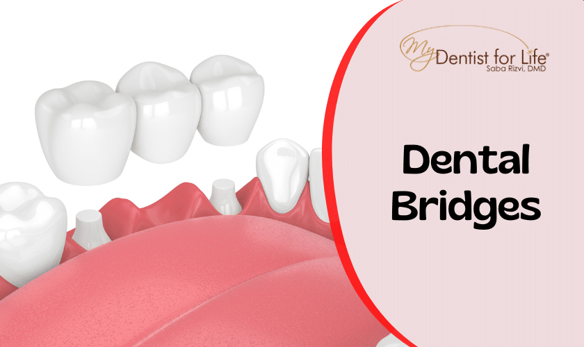 Aftercare Tips For Dental Bridges
