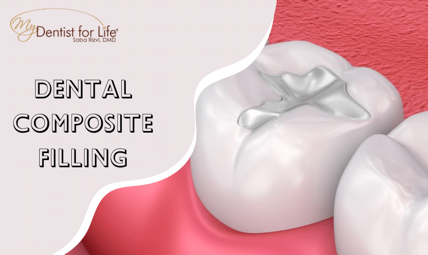 Dental Composite Filling