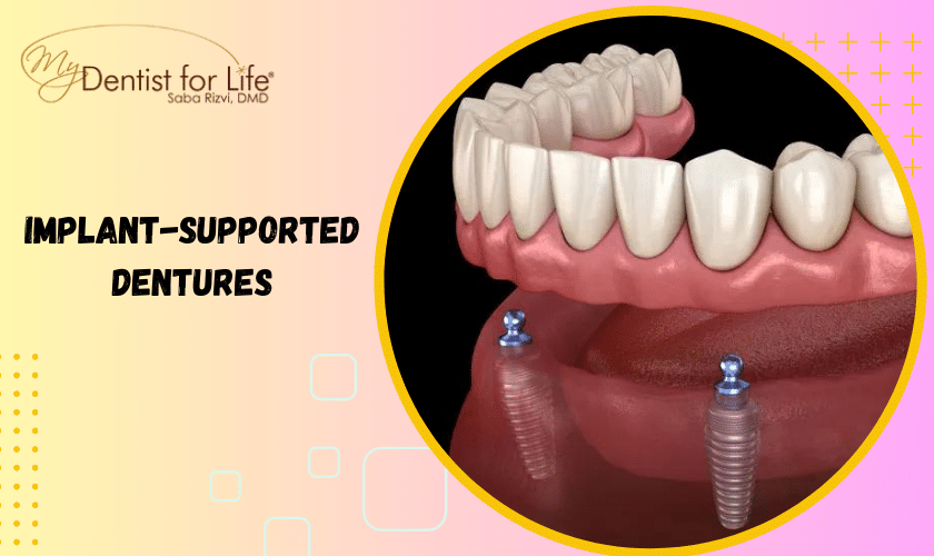 Implant-Supported Dentures