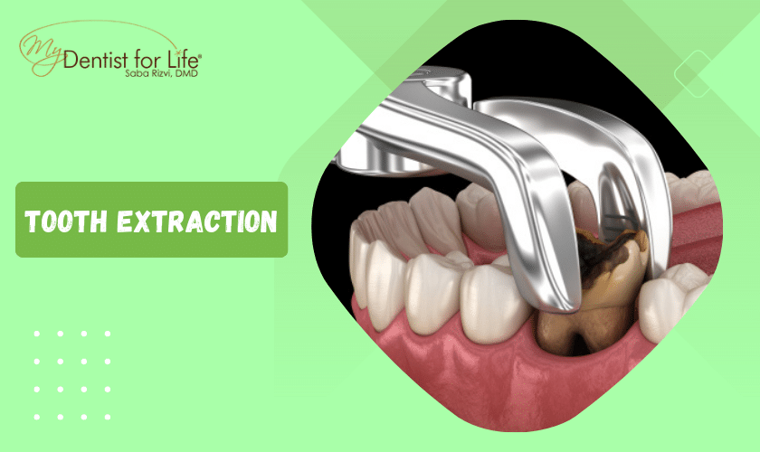 When is a Tooth Extraction Necessary
