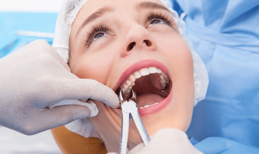 Wisdom Teeth Plantation - My dentist for life of Plantation