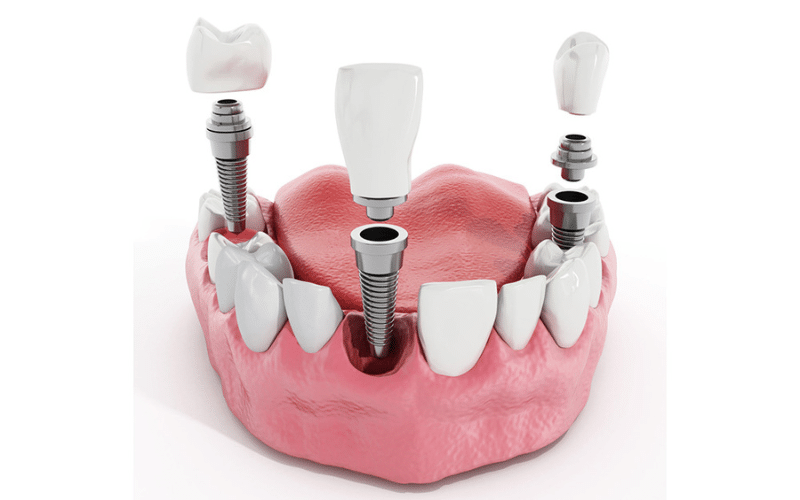 All-on-4 Dental Implants