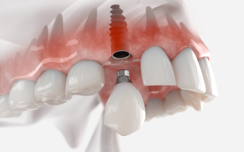 dental Implants