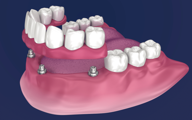 All-on-4 dental implants