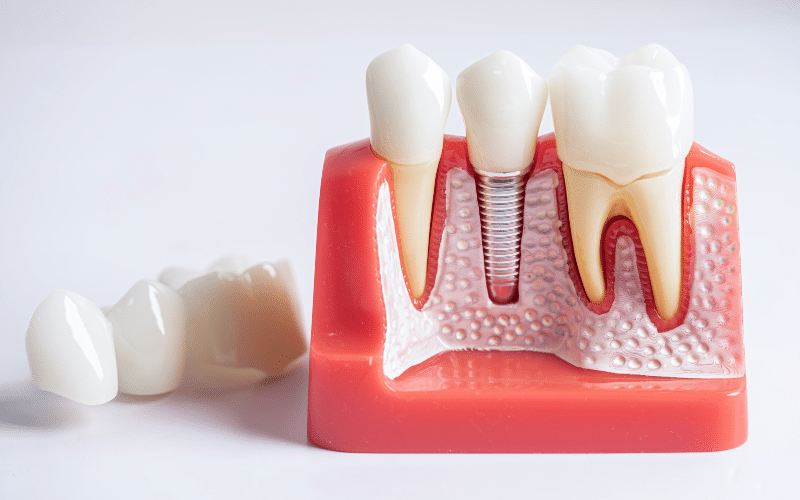 dental implants but worried about gum disease