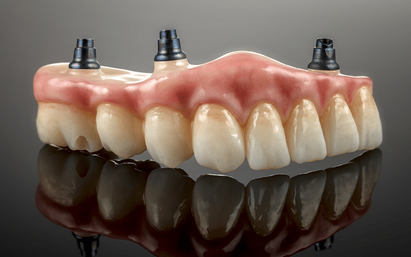 Custom-fitted Dentures