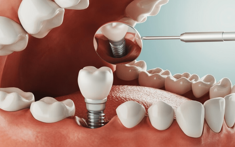 Dental Implant Surgery