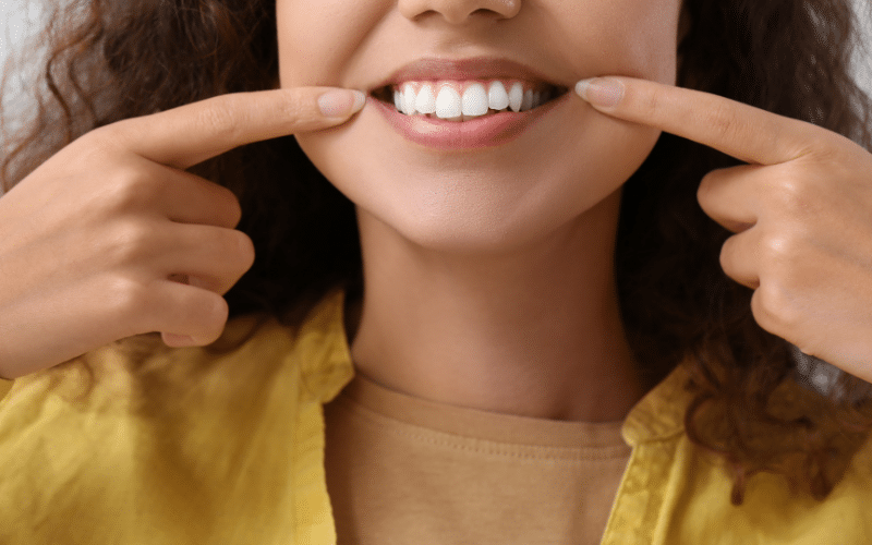 Dental veneers