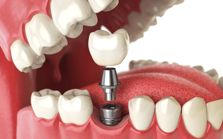 How to Care for Your Dental Implants to Ensure Longevity?