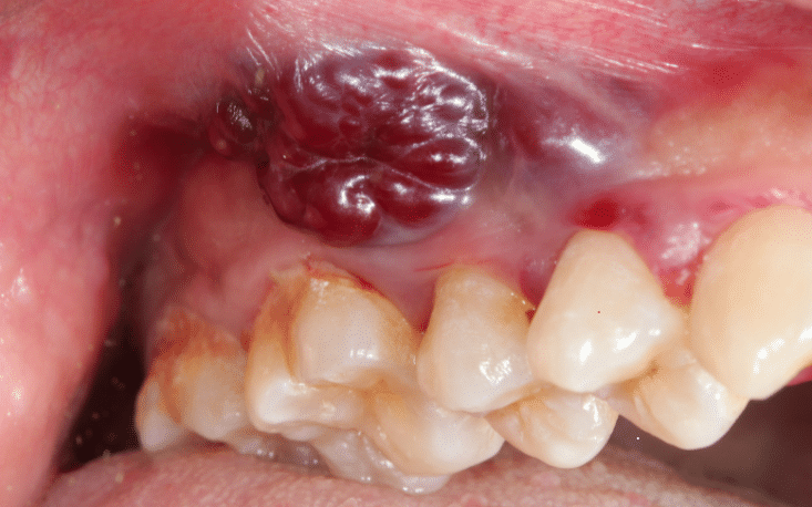 Why is Early Detection of Oral Cancer Crucial For Successful Treatment?