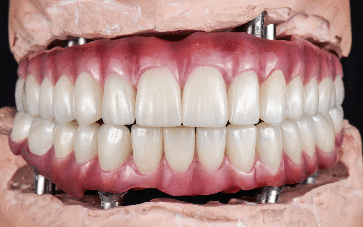 Why Are All-on-4 Dental Implants a Game-Changer for Full Mouth Restoration?