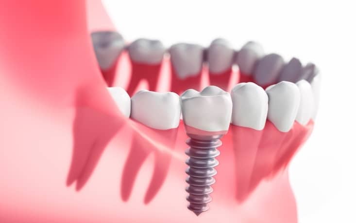 What Is The Recovery Process For Dental Implants?