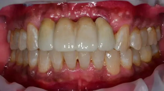 After cosmetic dental treatment showing the patient's restored and enhanced smile.