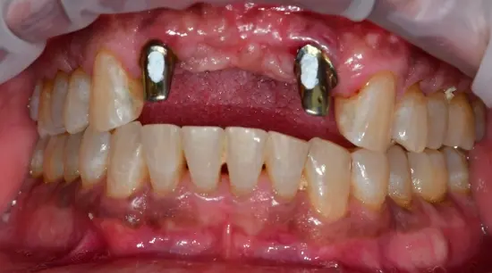Before cosmetic dental treatment showing the patient's smile prior to treatment.