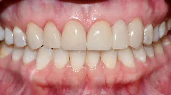After cosmetic dental treatment showing the patient's restored and enhanced smile.