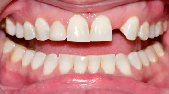 Before cosmetic dental treatment showing the patient's smile prior to treatment.