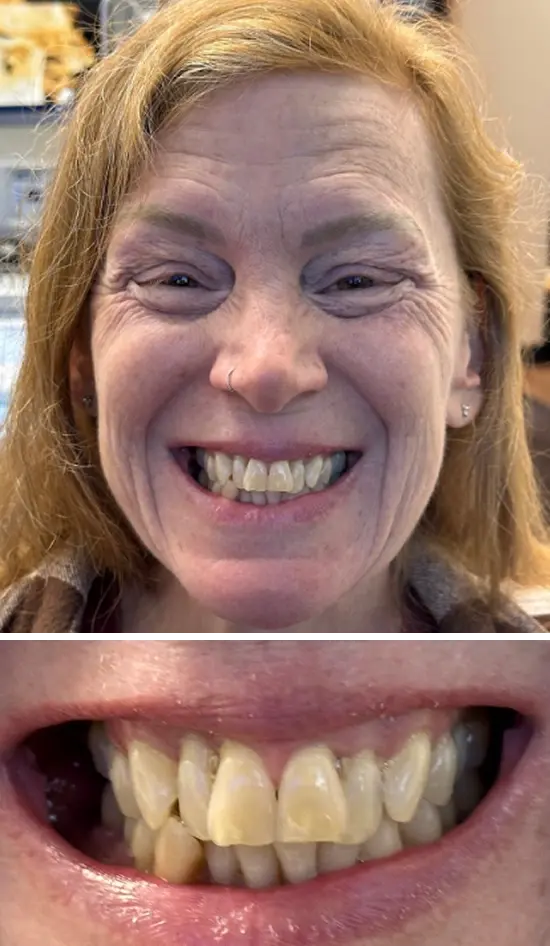 Before cosmetic dental treatment showing the patient's smile prior to treatment.