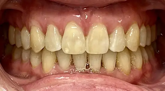 After cosmetic dental treatment showing the patient's restored and enhanced smile.