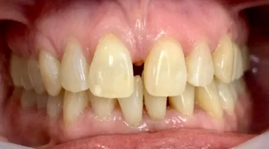 Before cosmetic dental treatment showing the patient's smile prior to treatment.