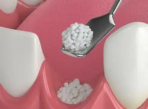 Dental bone graft material shown on instruments during implant preparation procedure.