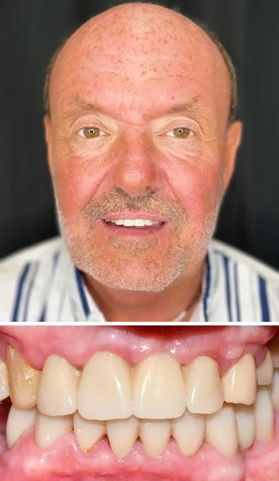 After cosmetic dental treatment showing the patient's restored and enhanced smile.
