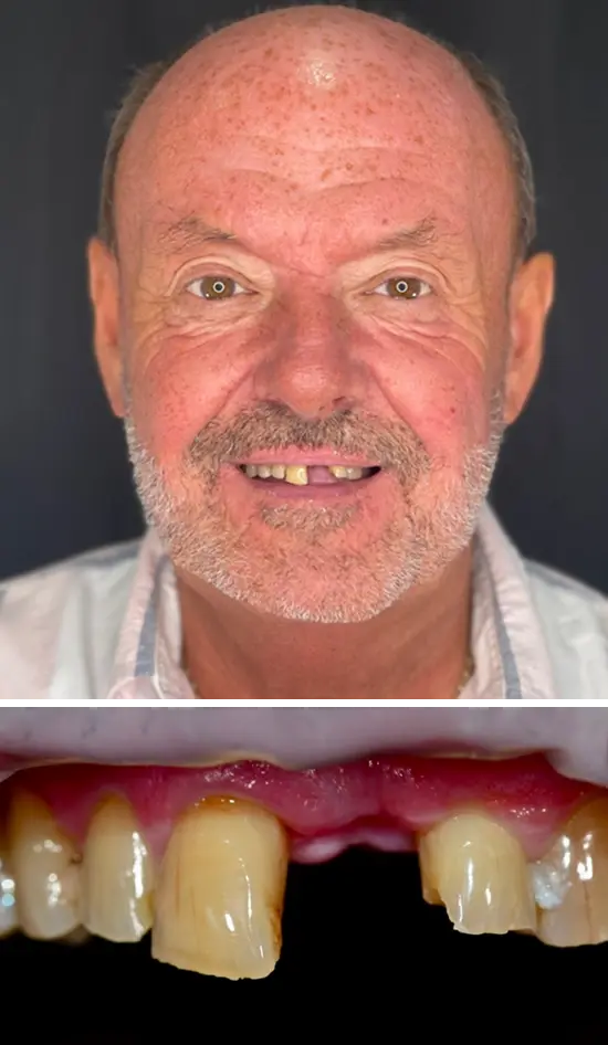 Before cosmetic dental treatment showing the patient's smile prior to treatment.