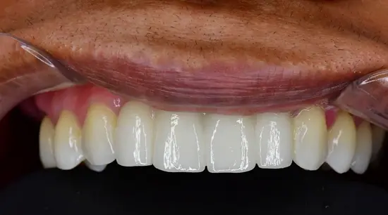 After cosmetic dental treatment showing the patient's restored and enhanced smile.