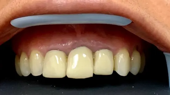 Before cosmetic dental treatment showing the patient's smile prior to treatment.