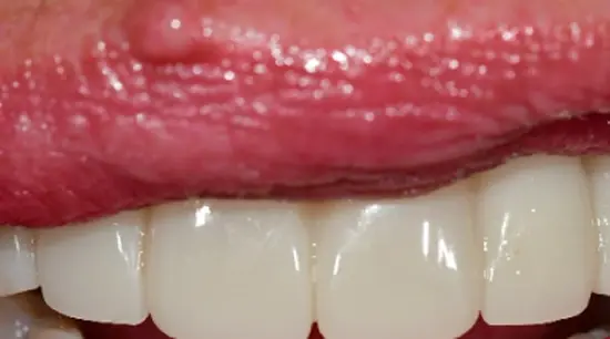 After cosmetic dental treatment showing the patient's restored and enhanced smile.