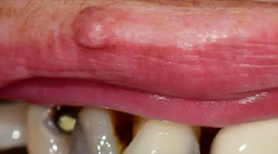 Before cosmetic dental treatment showing the patient's smile prior to treatment.