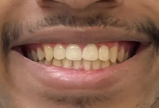 Close-up of patient's smile showing whitened teeth after cosmetic dental treatment in Plantation, FL.