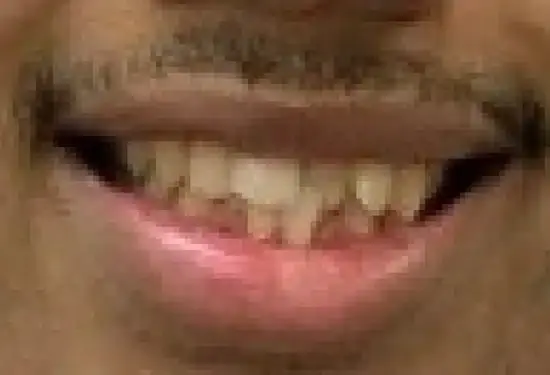 Patient's smile showing before dental treatment with visible tooth discoloration and alignment issues.