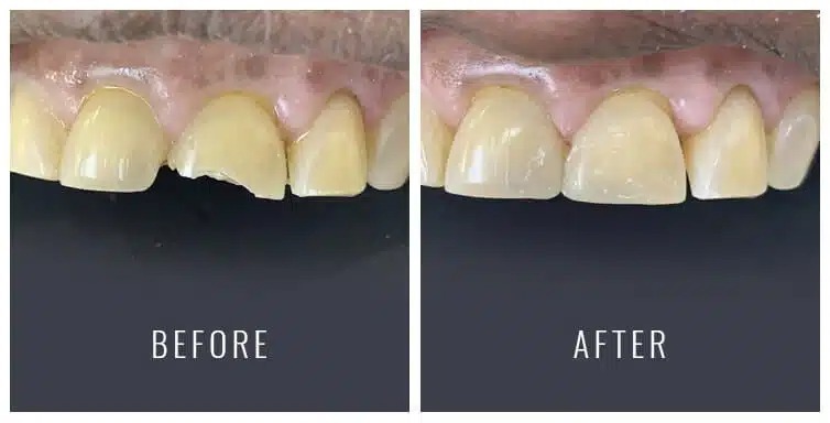 Before and after composite filling treatment showing improved tooth restoration and natural appearance.