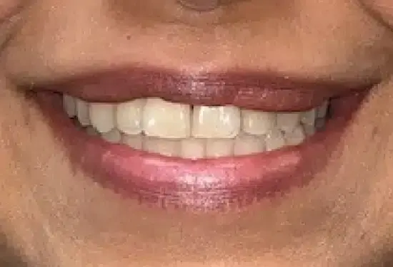 Close-up of a patient's smile showing straight, white teeth after orthodontic treatment.