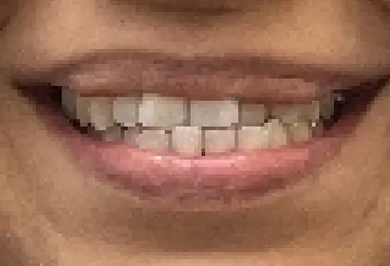 Close-up of crowded upper teeth before orthodontic treatment in Plantation, FL.