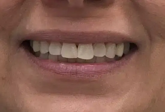 Close-up of a patient's bright smile showing natural-looking teeth after cosmetic dental treatment.