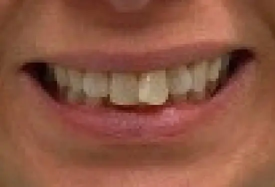 Close-up of a healthy smile showing straight, white teeth and natural gum line.