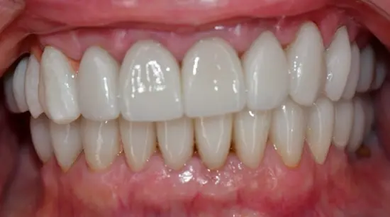 After cosmetic dental treatment showing the patient's restored and enhanced smile.